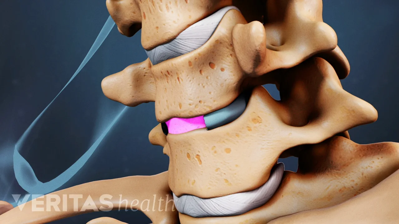Potential Risks and Complications of ACDF Surgery | Spine-health