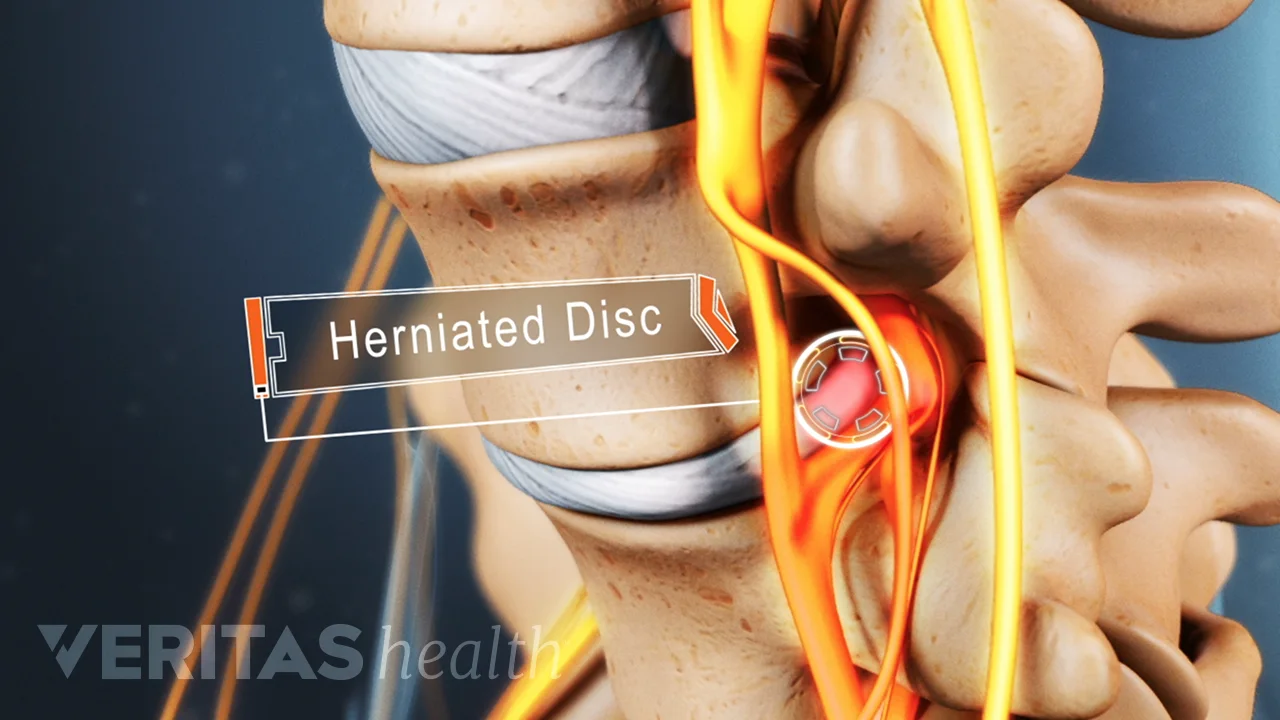 Exercises to Avoid with a Lumbar Herniation Spine health