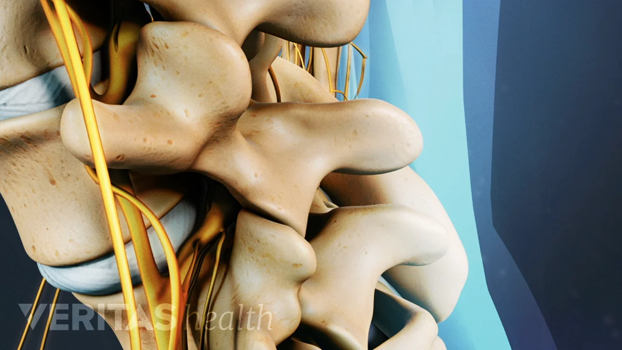 Microdiscectomy Spine Surgery: Risks, Complications, and Success Rates ...