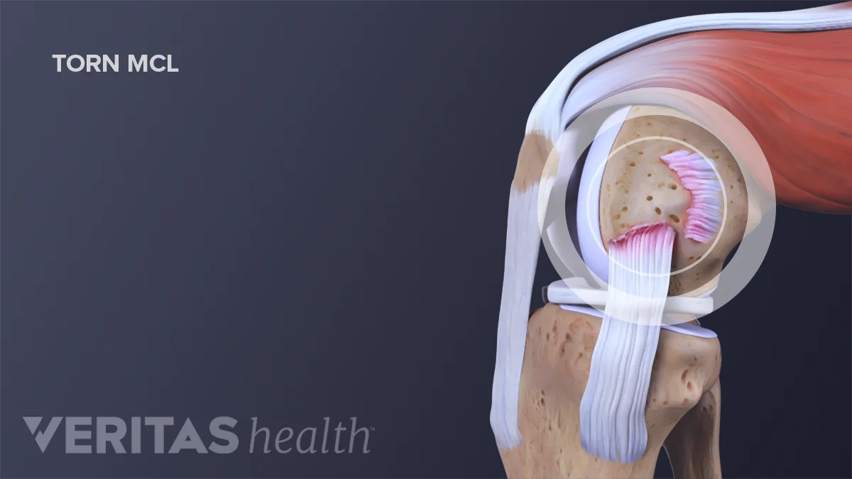 MCL Sprains and Tears: Causes and Risk Factors | Sports-health