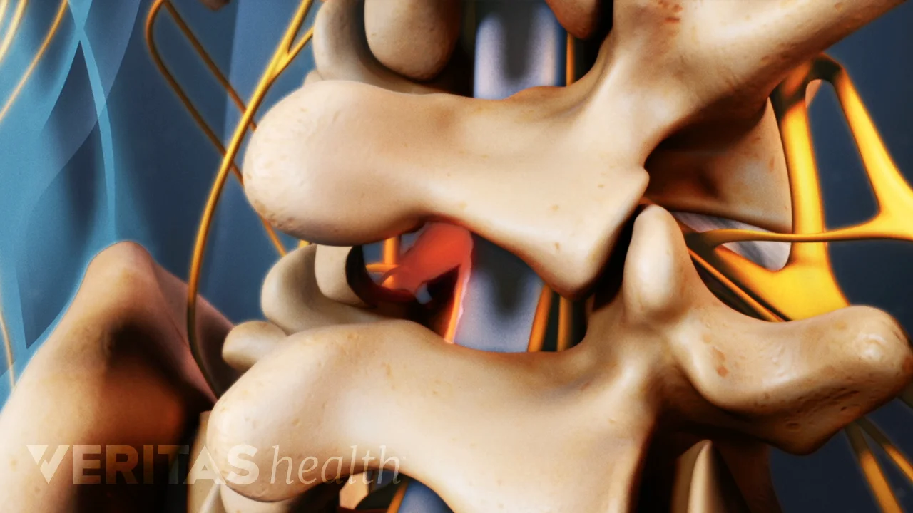 Lumbar Microdiscectomy Recovery: Weeks 6 to 12 | Spine-health