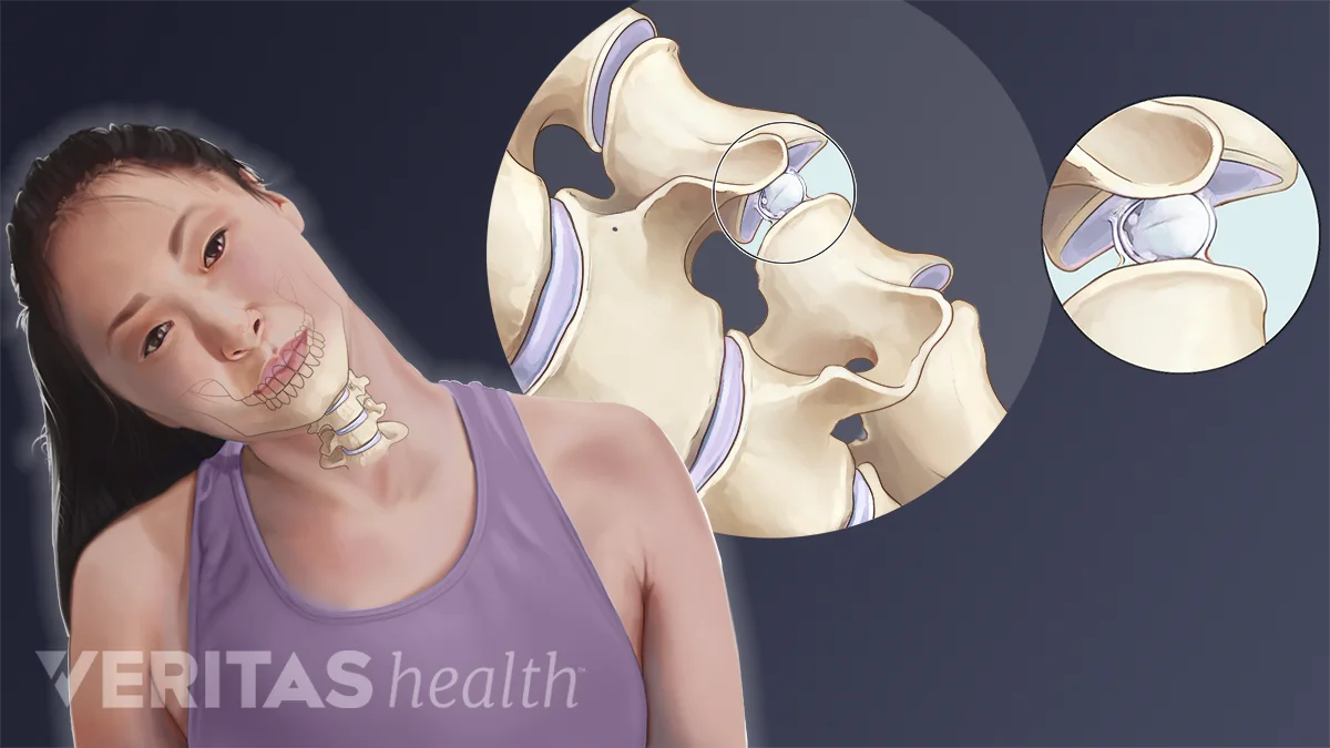 Should I Worry About My Neck Cracking? | Spine-health