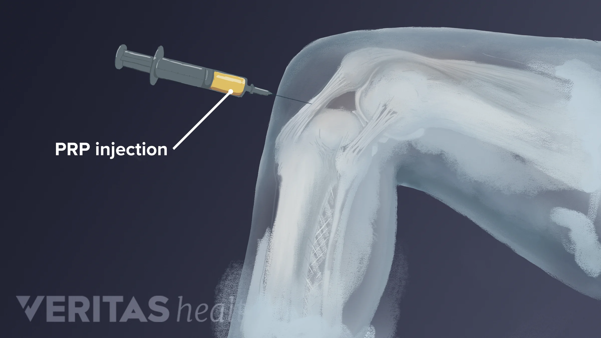 Pop Injection Efficacy of Platelet-Rich Plasma Injections | Arthritis-health