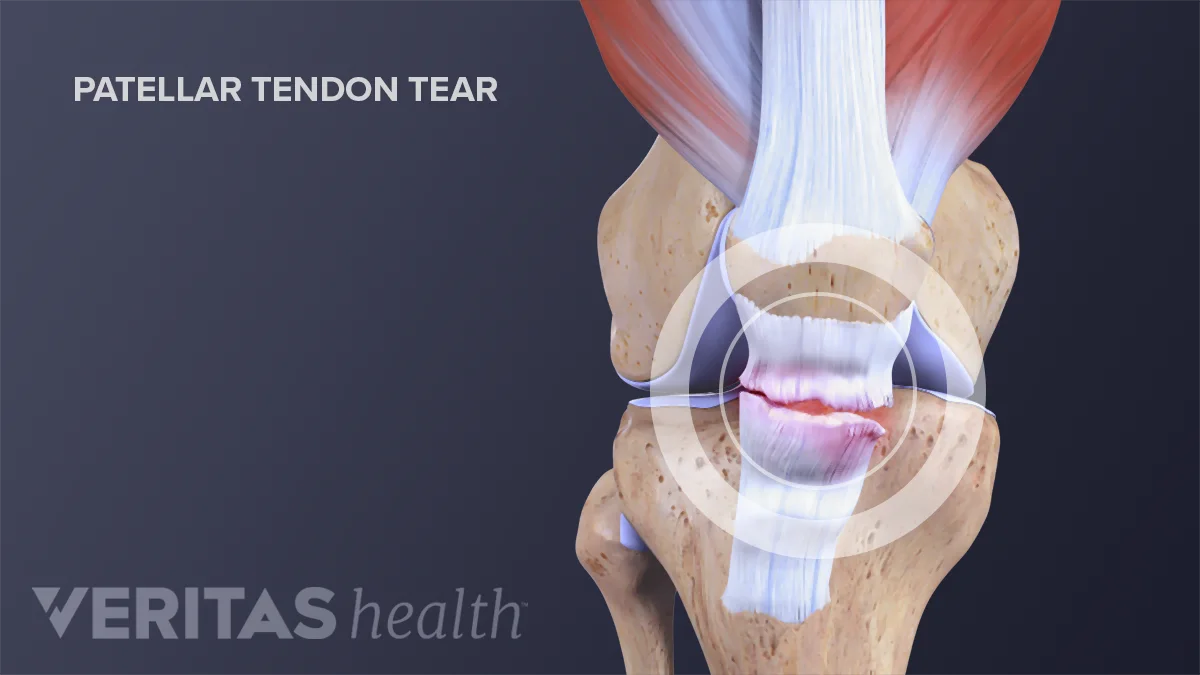 What You Need to Know About Kneecap Injuries Sports health