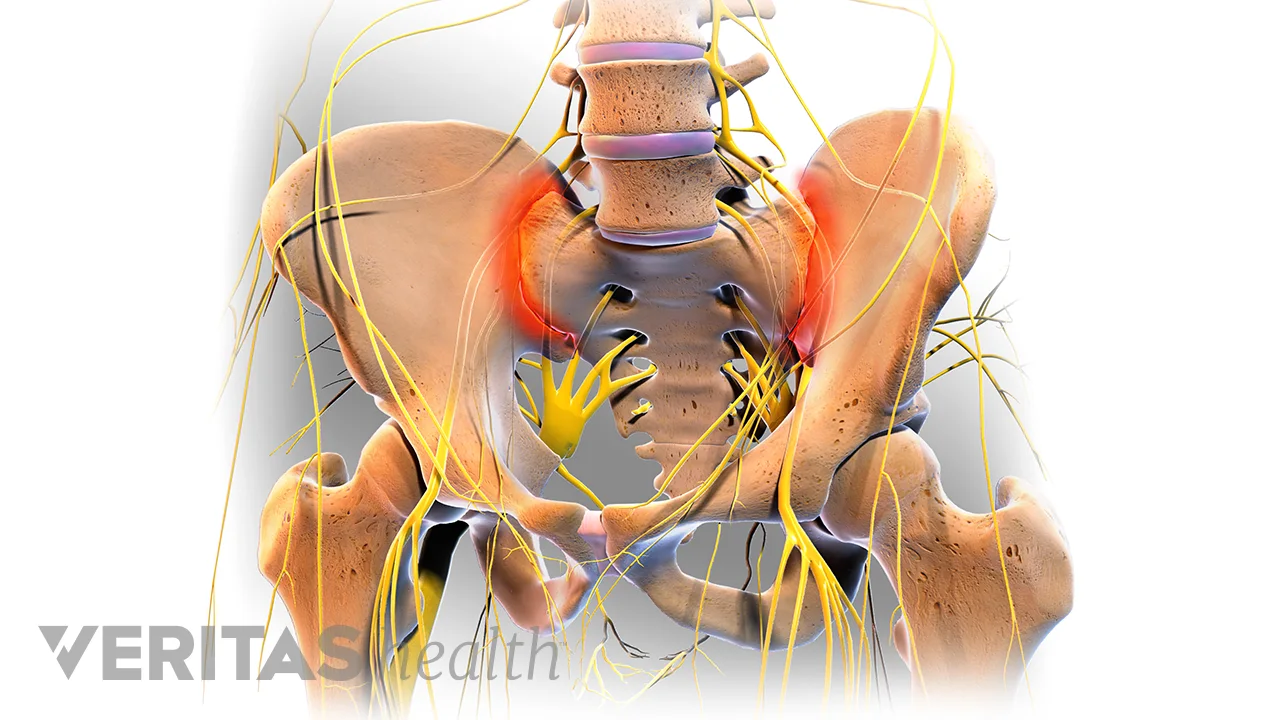 All About Sacroiliitis | Spine-health