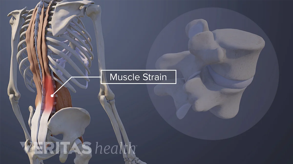 Lower Back Muscle Strain or Sprain Video | Spine-health