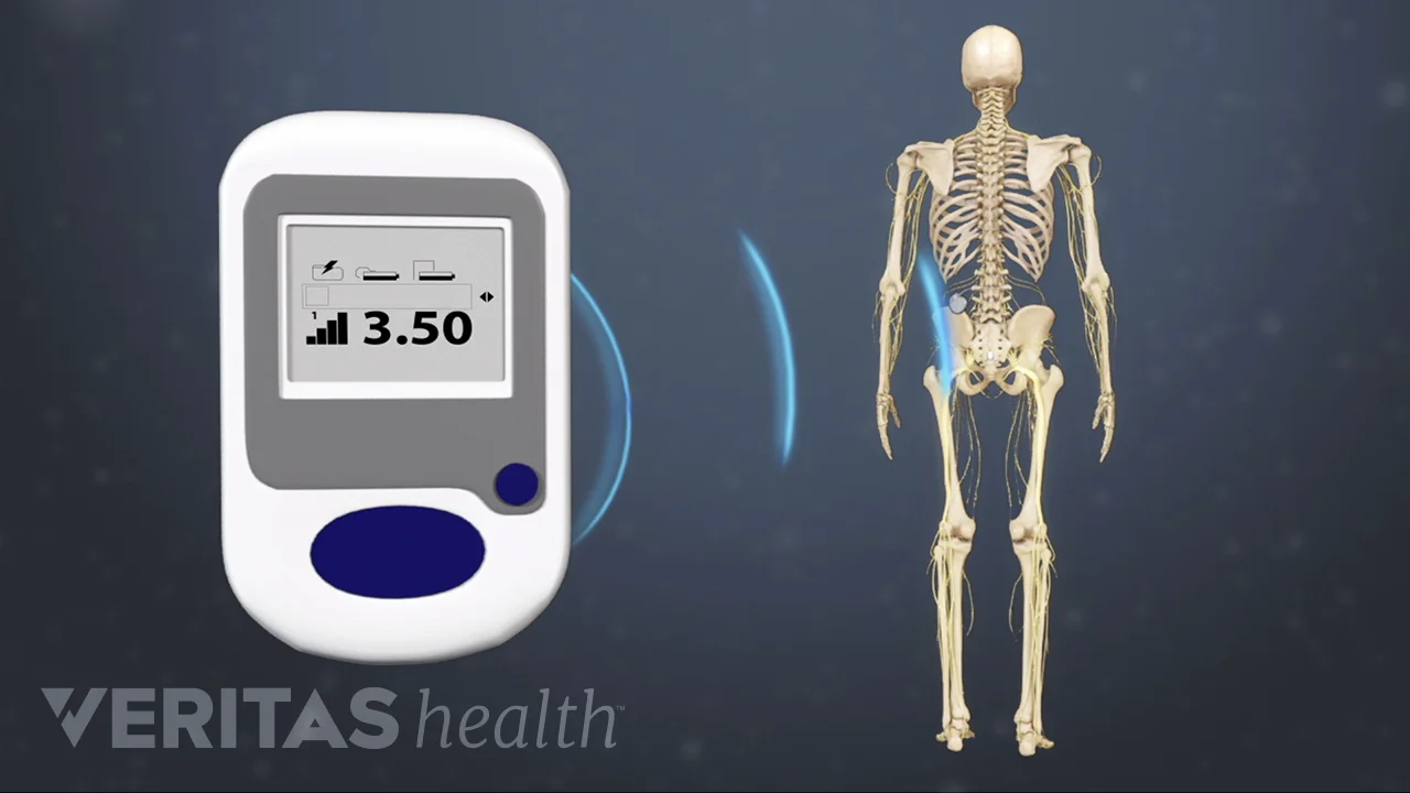 Recovery After a Permanent Implant for SCS Treatment Spinehealth