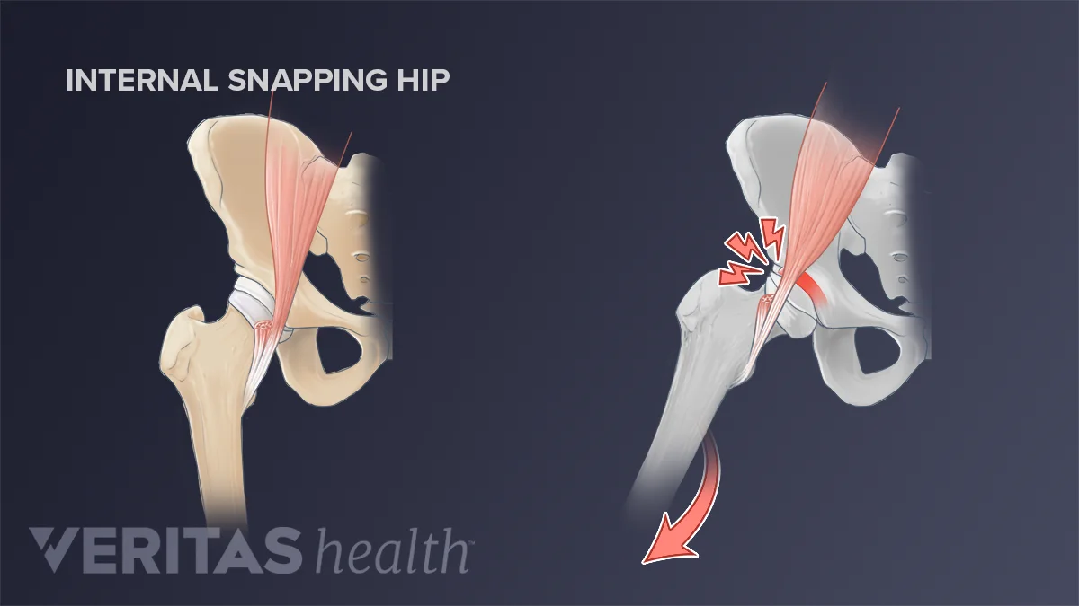 Pop, Click, Snap: Snapping Hip Syndrome | Sports-health