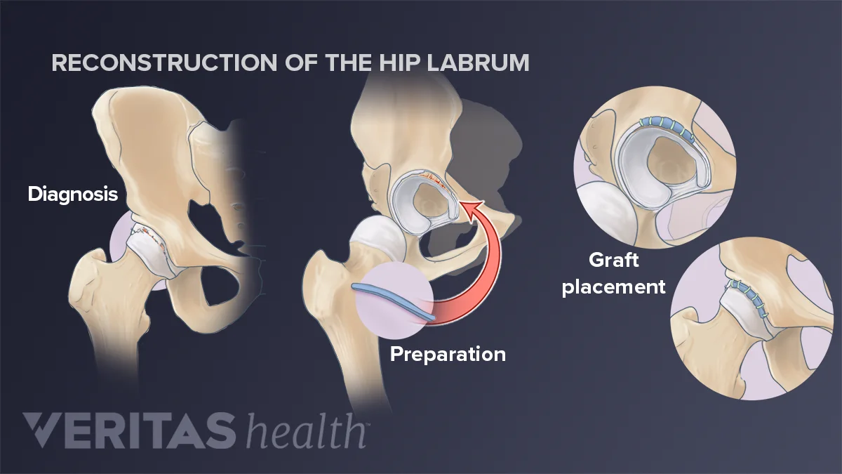 Hip Labral Reconstruction: Surgical Steps and Recovery | Sports-health