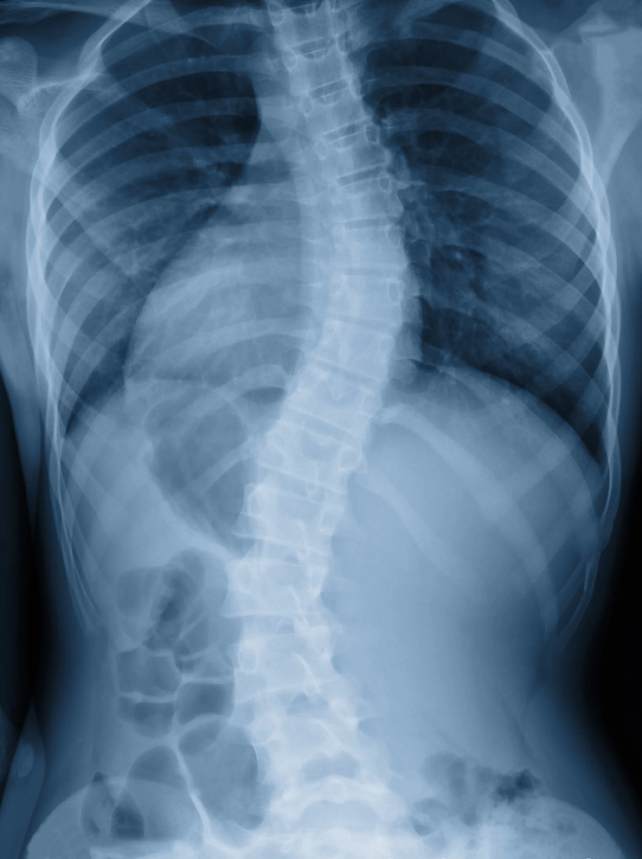 Scoliosis Symptoms | Spine-health
