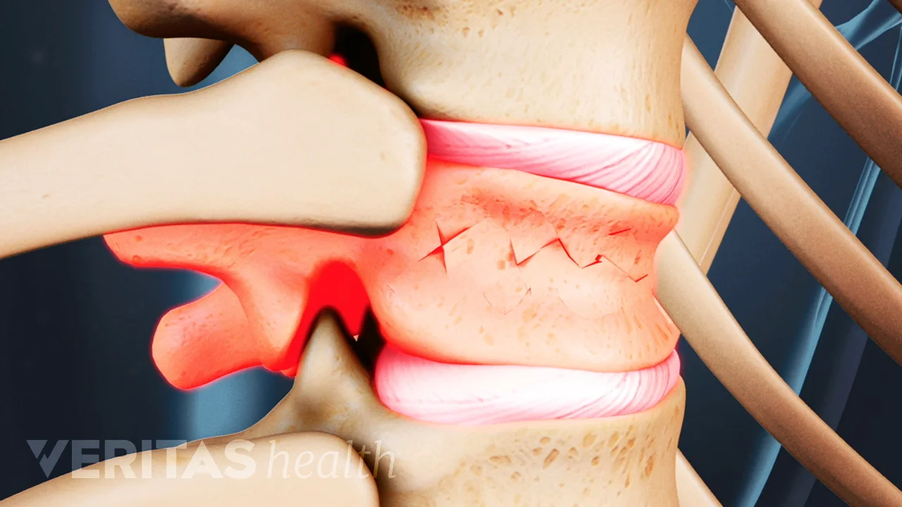 Spinal Compression Fracture Video | Spine-health