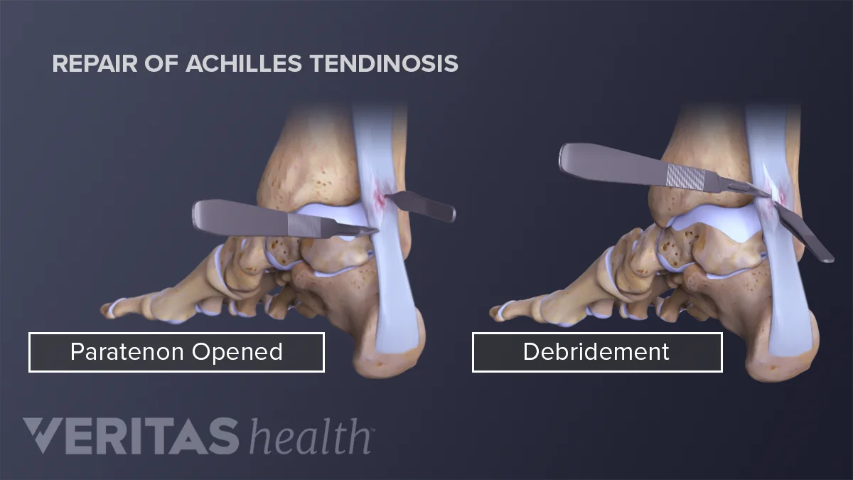 Injections and Surgery to Treat Achilles Pain Injections and Surgery to Treat Achilles Pain