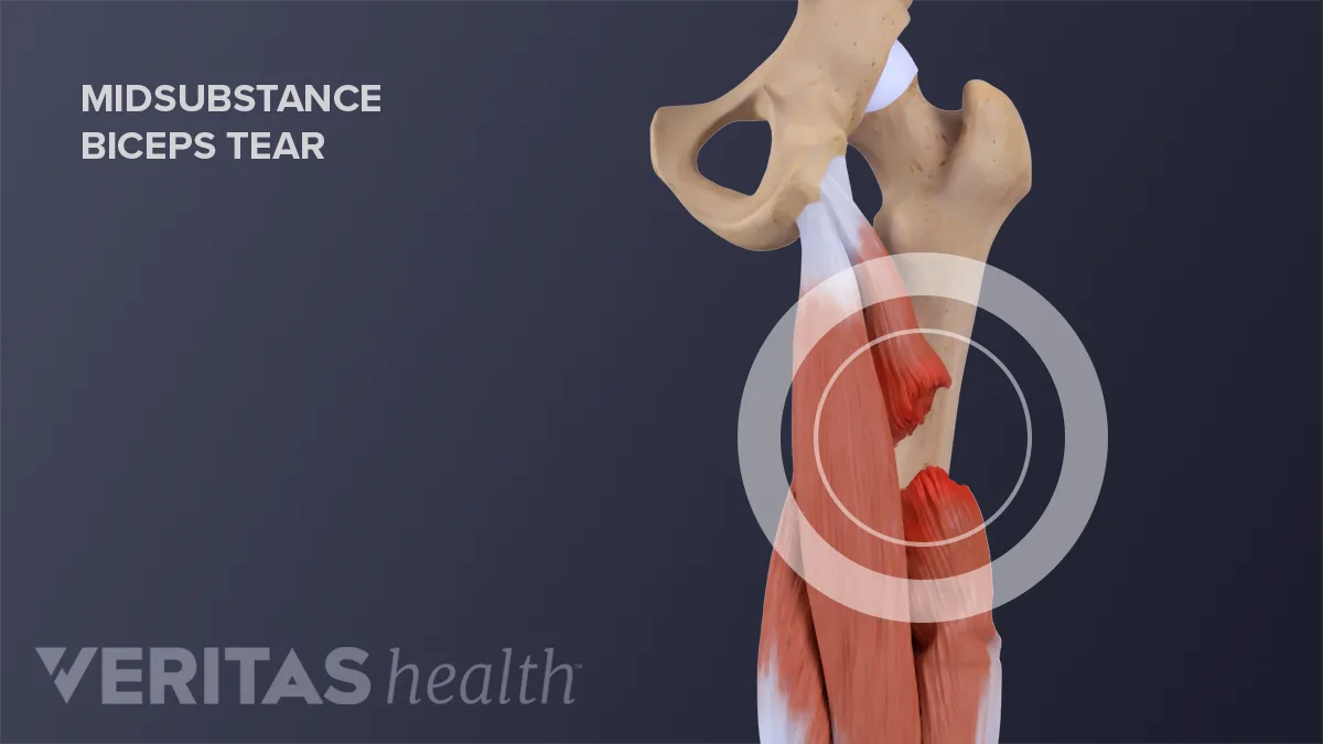 Hamstring Broke Hamstring Tears: Causes and Risk Factors