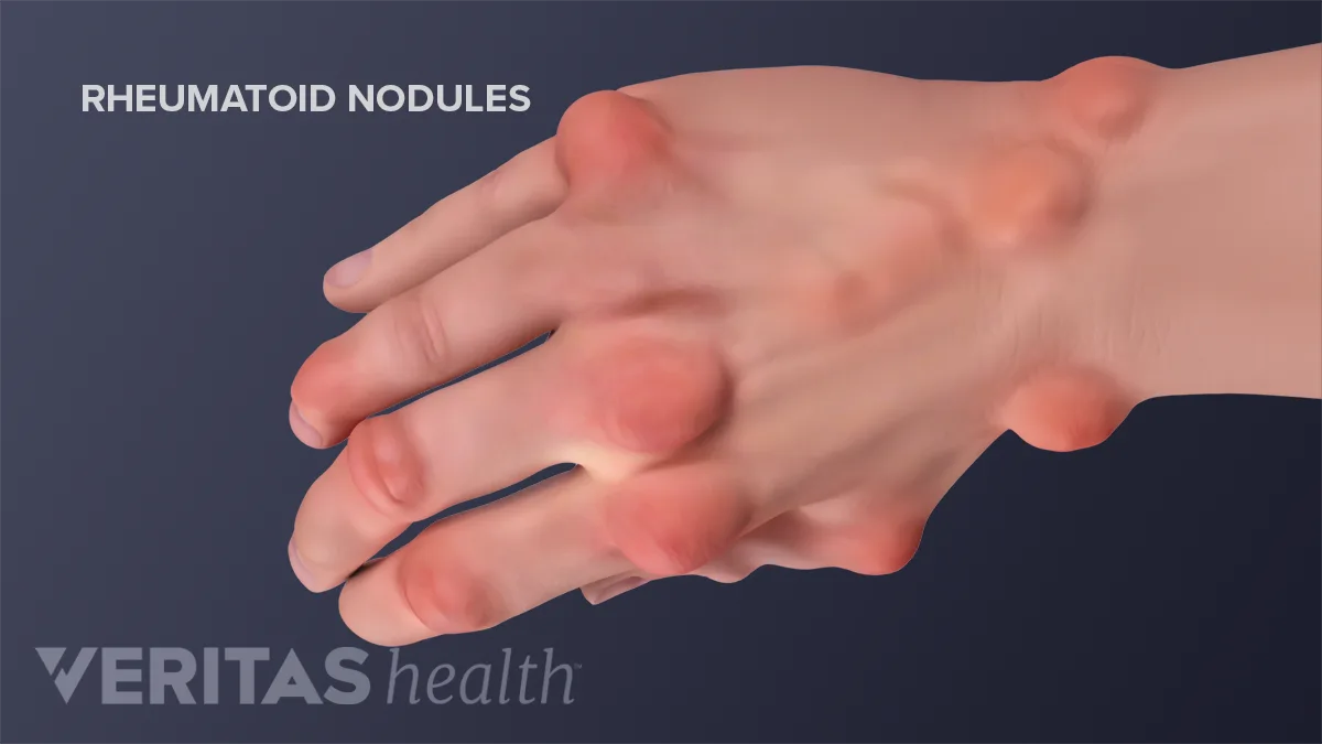 Rheumatoid Arthritis Nodules On Fingers