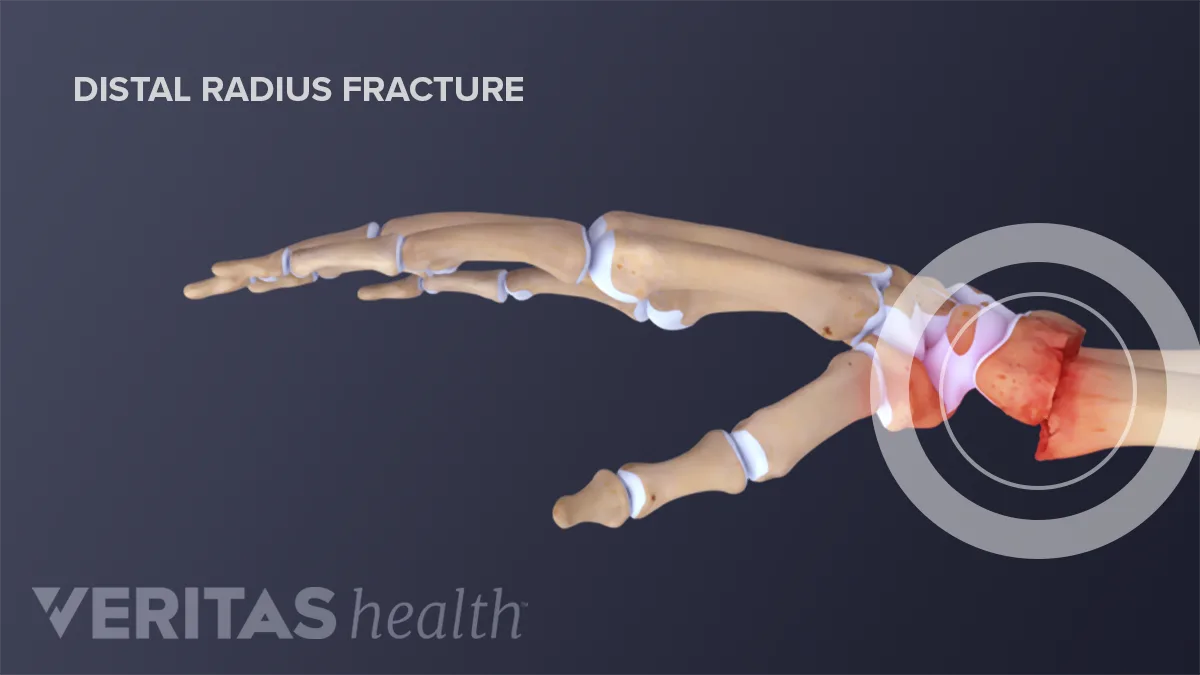 Distale Radius Is My Wrist Broken or Sprained?