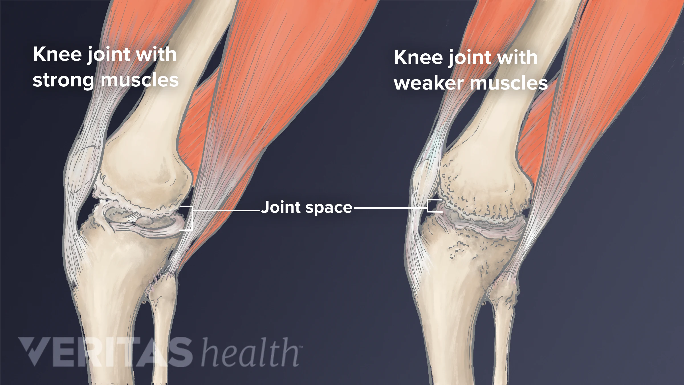 Knee Exercises for Arthritis Knee Exercises for Arthritis