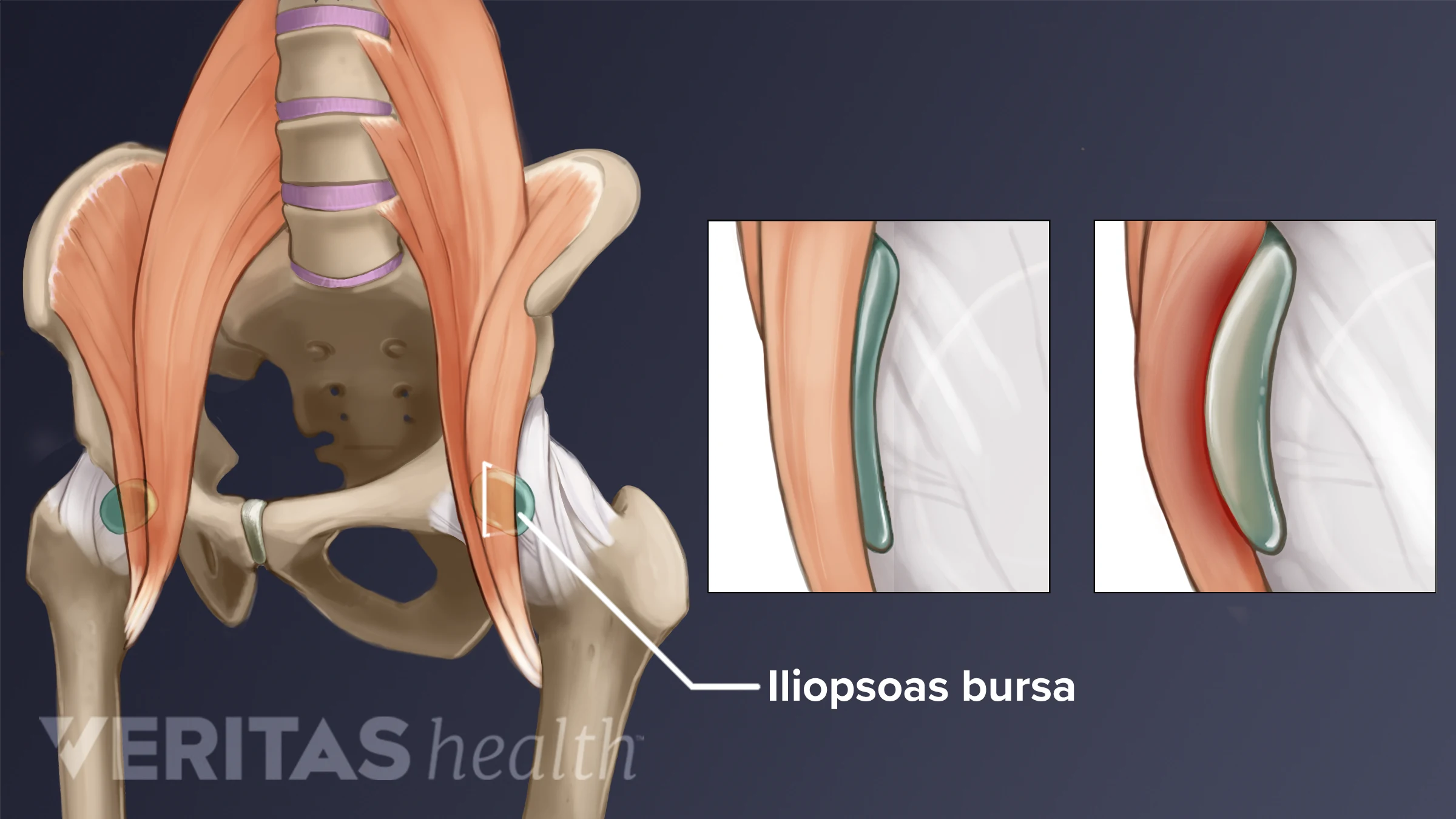 Medical illustration of the iliopsoas muscle and bursa showing hip flexor anatomy