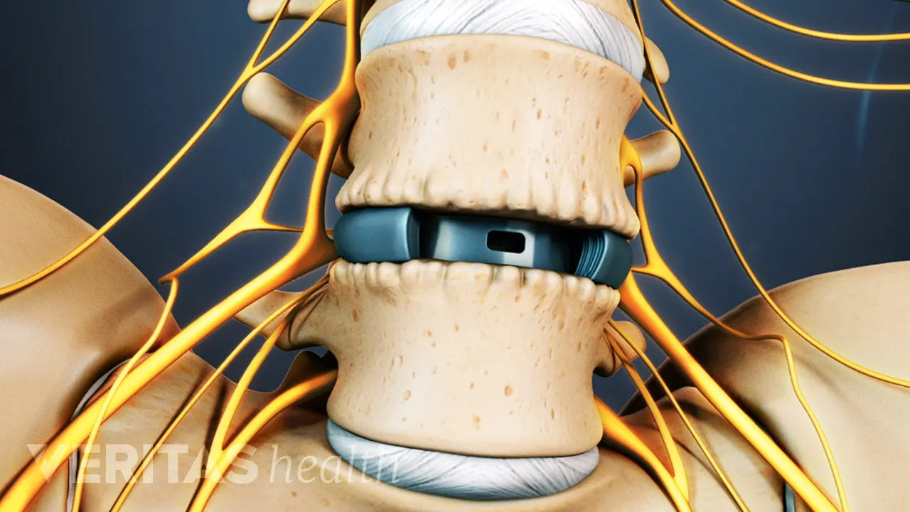 ALIF (Anterior Lumbar Interbody Fusion) Video