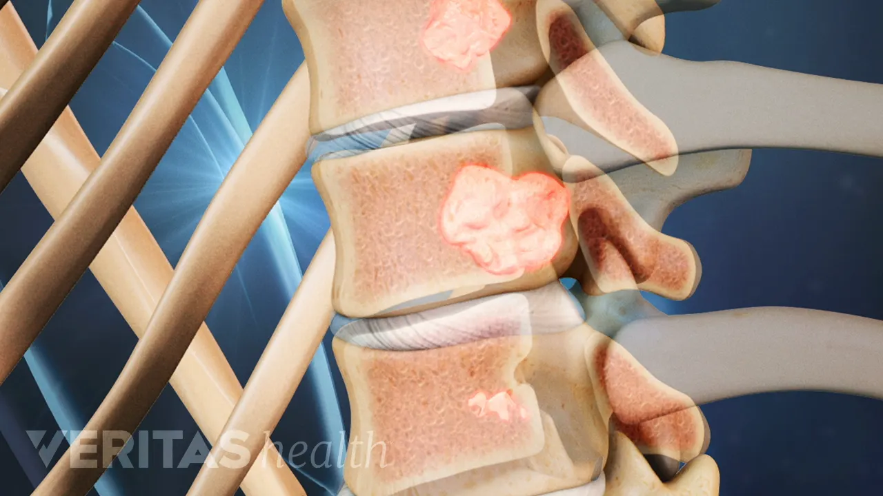 Symptoms of a Spinal Tumor