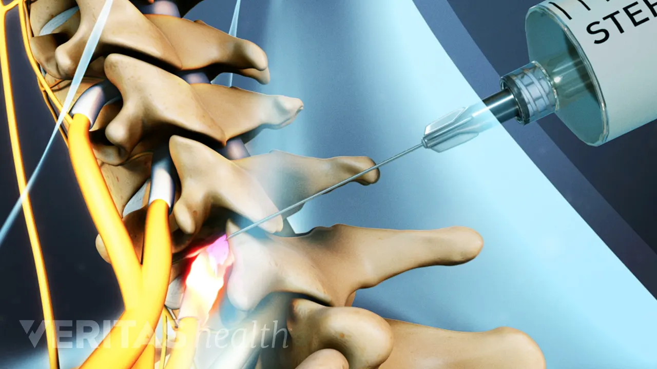 Selective Nerve Block Injection Selective Nerve Root Block Injections