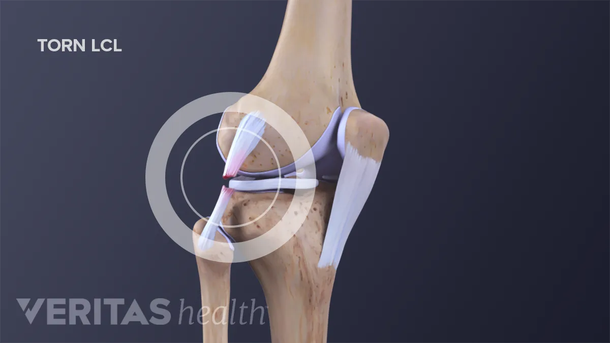Lcl Leg Lateral Collateral Ligament (LCL) Injuries