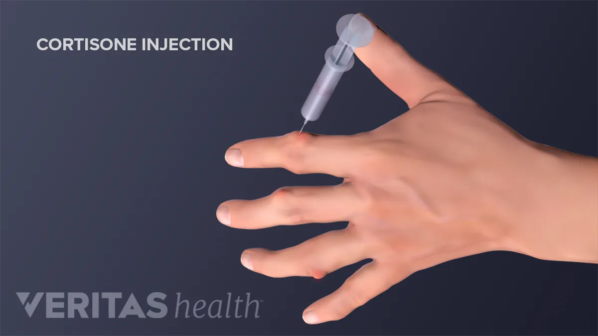 Cortisone Injection Risks and Side Effects