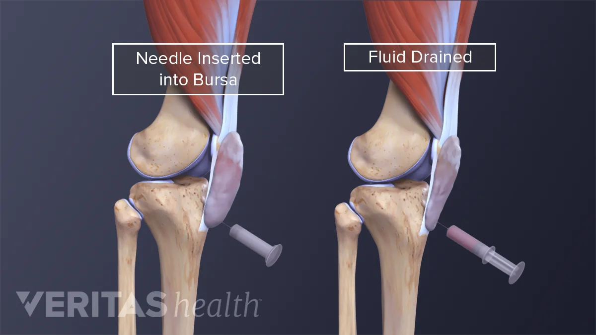 Prepatellar Bursitis Treatment