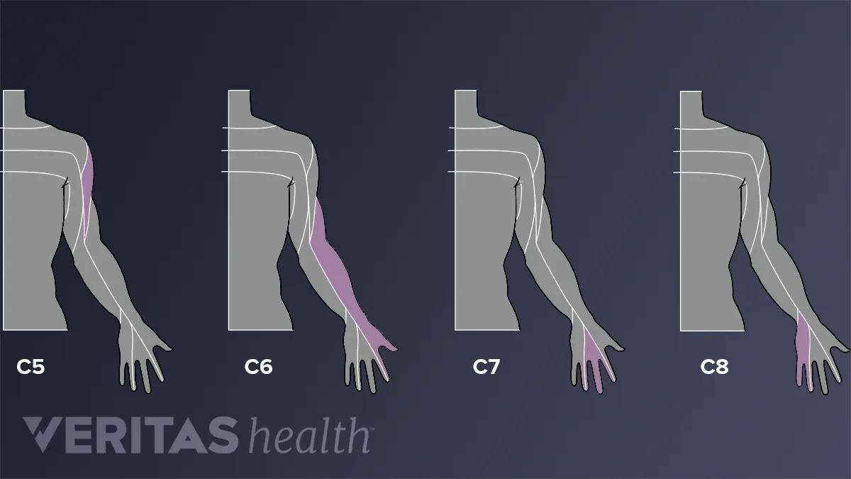 C8 Distribution Pattern C8 Dermatome Distribution Chart Dermatome Map Hi Res Stock Photography