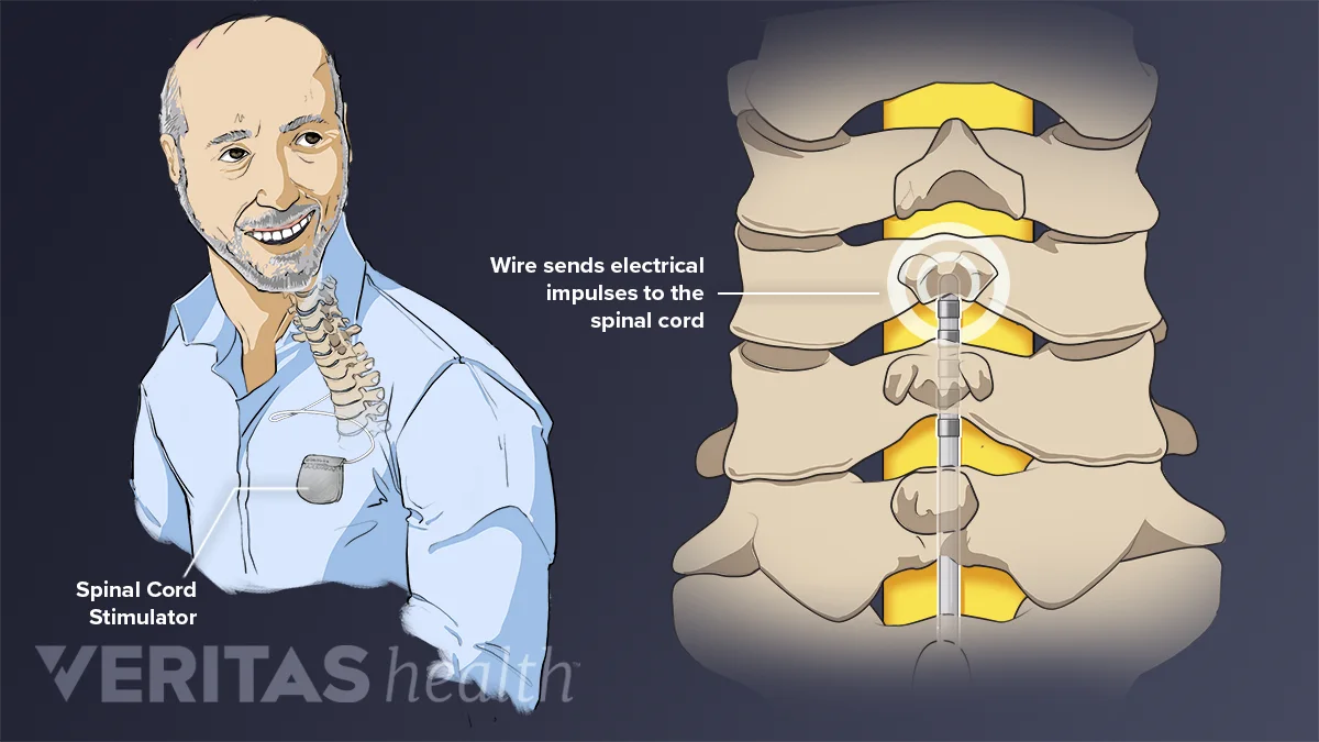 Stimulator Spinal Cord Stimulators and Pain Pumps: Implantable Systems for Neuropathy