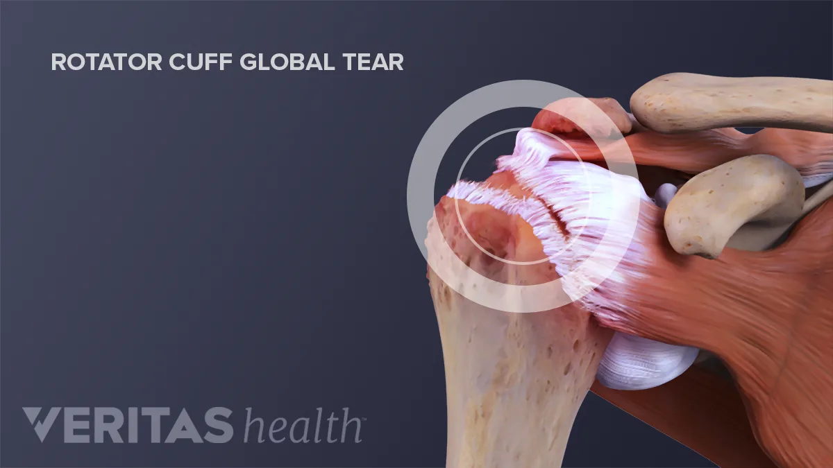 Rotator Cuff Disease Definition Risk Factors Anatomy Symptoms And