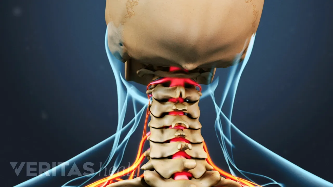Cervical Radiculopathy from a Herniated Cervical Disc
