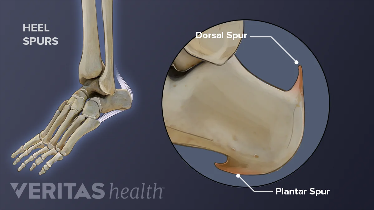 The 2 Common Types of Heel Spurs