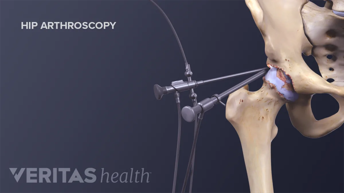 Minimally Invasive Hip Replacement Procedure