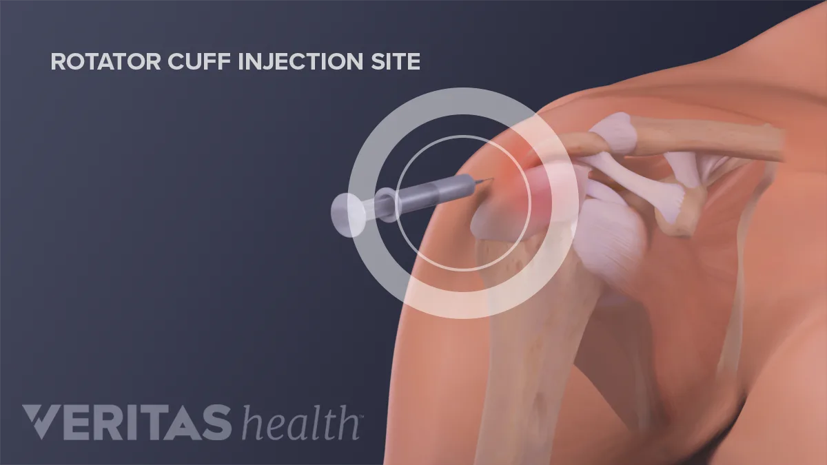 Rotator Cuff Injections Rotator Cuff Injections