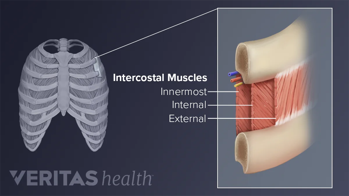 Upper Back Pain from Intercostal Muscle Strain