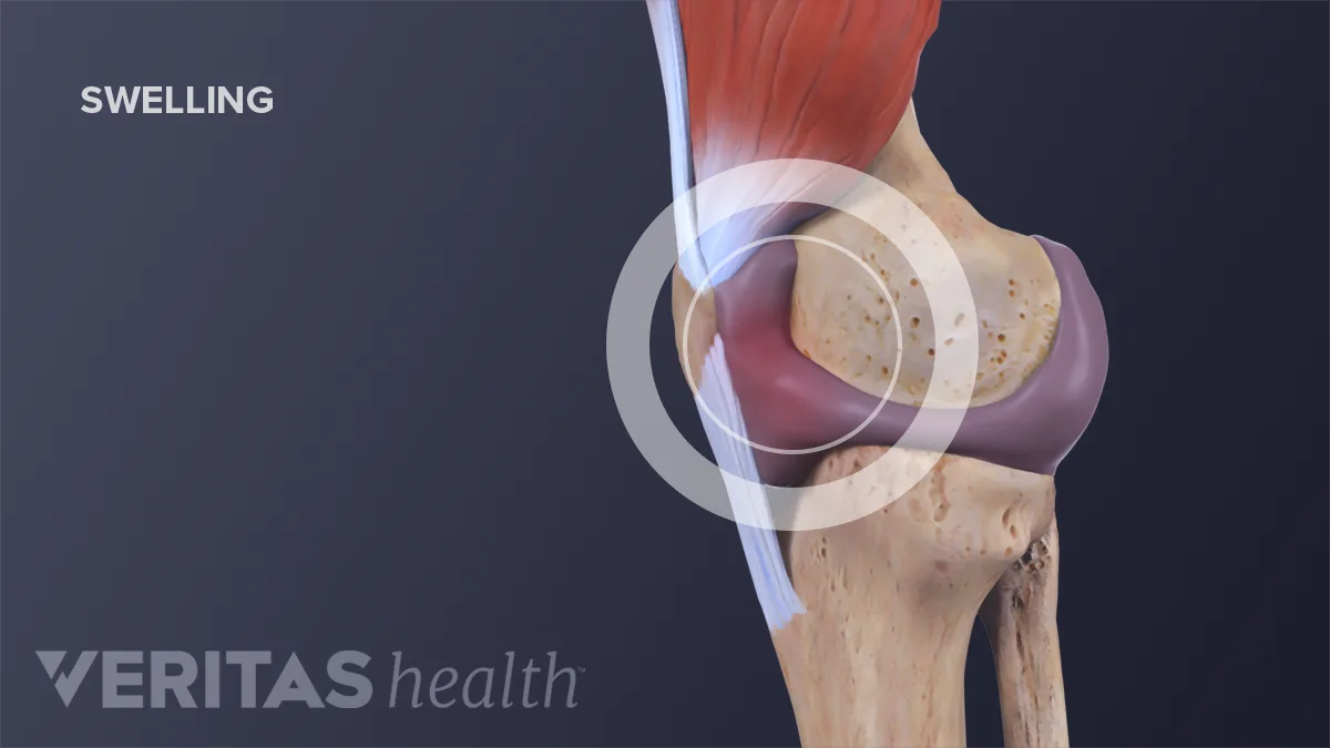 Swell Injury What Does It Mean When Your Knee Swells And Hurts