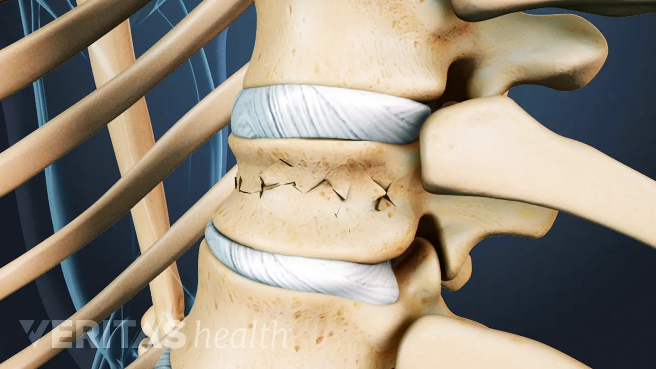 Spinal Compression Features Types of Spinal Compression Fractures
