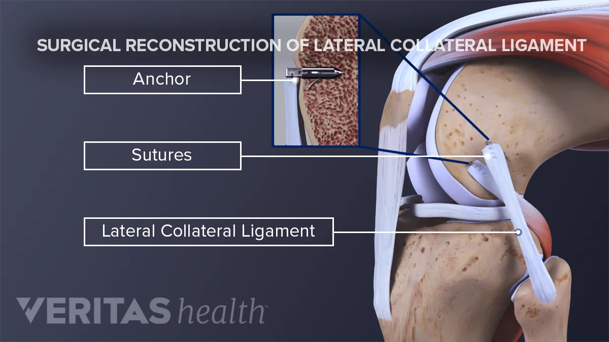 Fibular Collateral Ligament Tear Medial Collateral Ligament Injury