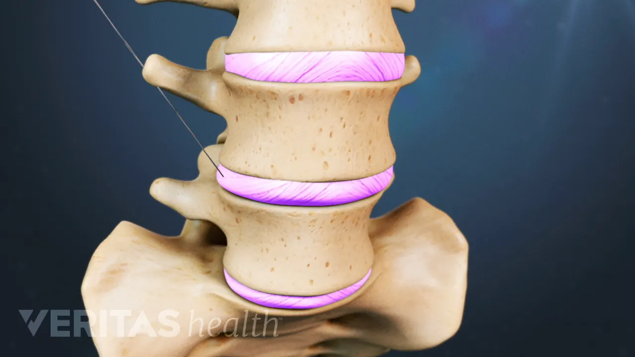 Dicagram Potential Side Effects and Risks of Discogram