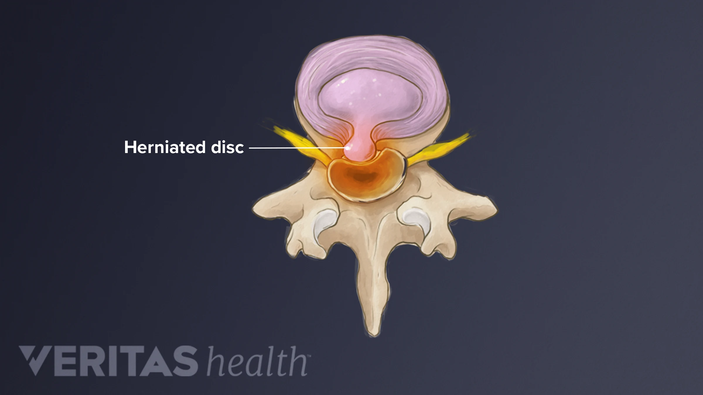 Disk Child Diagnosing a Lumbar Herniated Disc