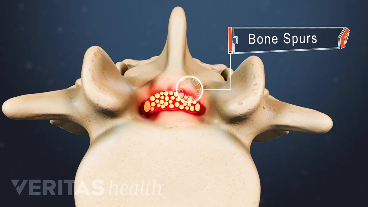 Bone Spur Example Bone Spur Causes