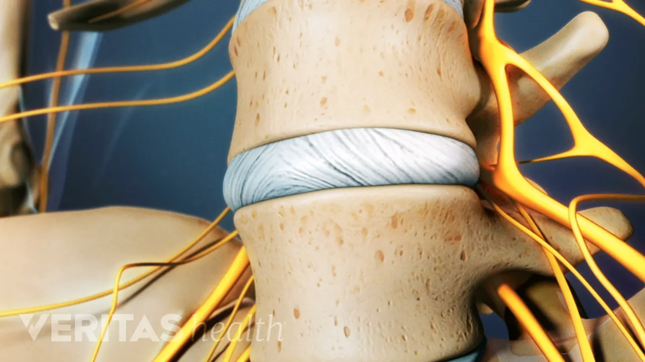 Lumbar Discogram Procedure