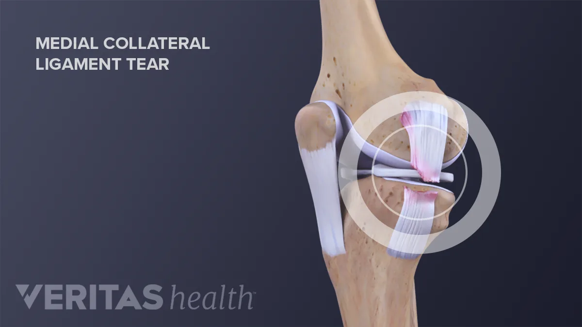 Mcl Injection Medial Collateral Ligament (MCL) Tears and Sprains