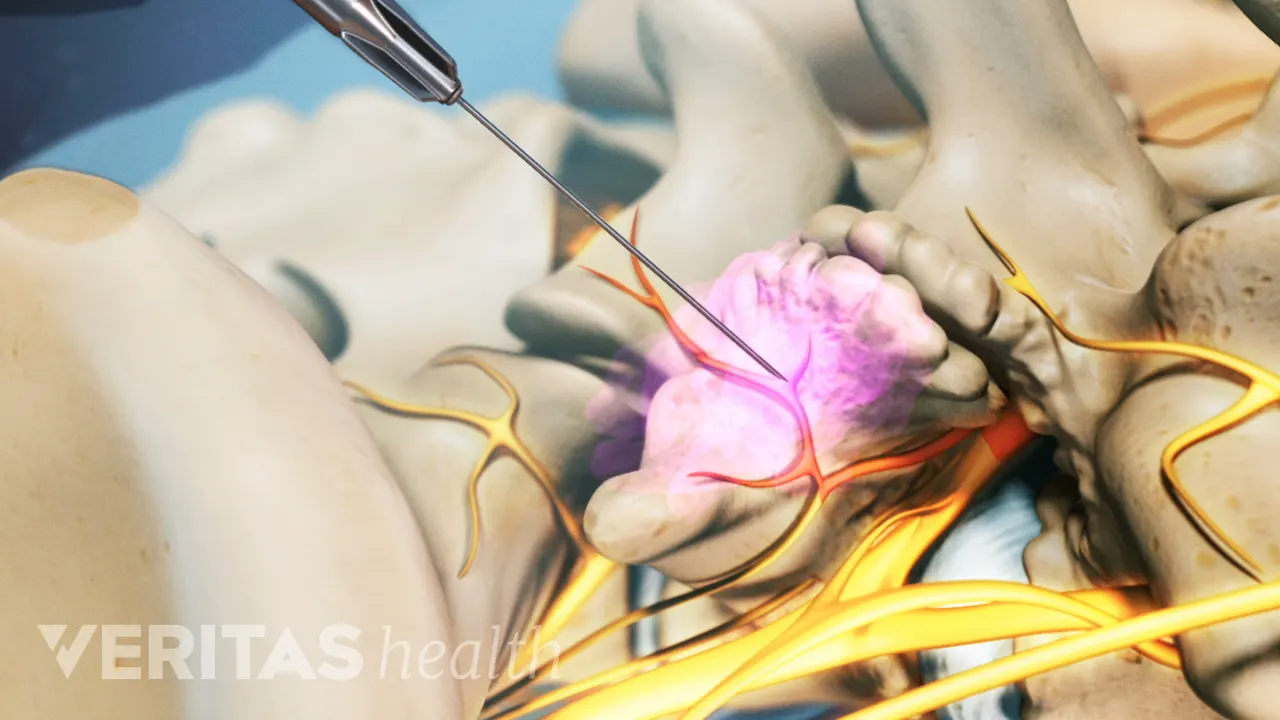 Medial Injection Medial Branch Injection Procedure