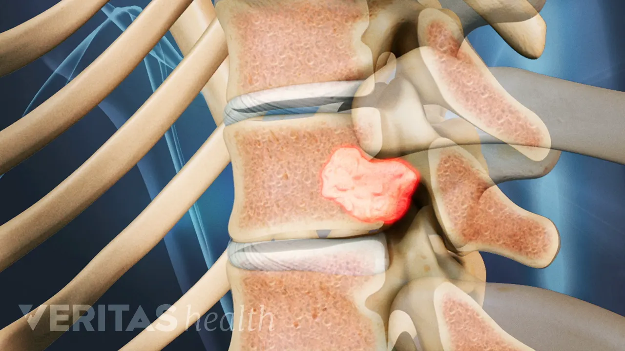 Treatments for Spinal Tumors