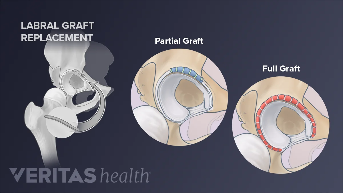 Labral Flap Hip Labral Reconstruction Surgery