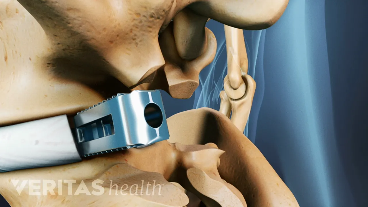 Acdr Outpatient Anterior Cervical Discectomy and Fusion (ACDF)