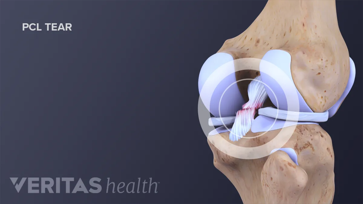 Diagnosing Posterior Cruciate Ligament (PCL) Tears