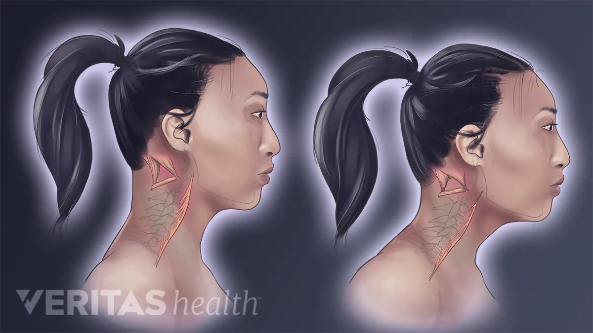 Fhp Back Forward Head Posture’s Effect on Neck Muscles