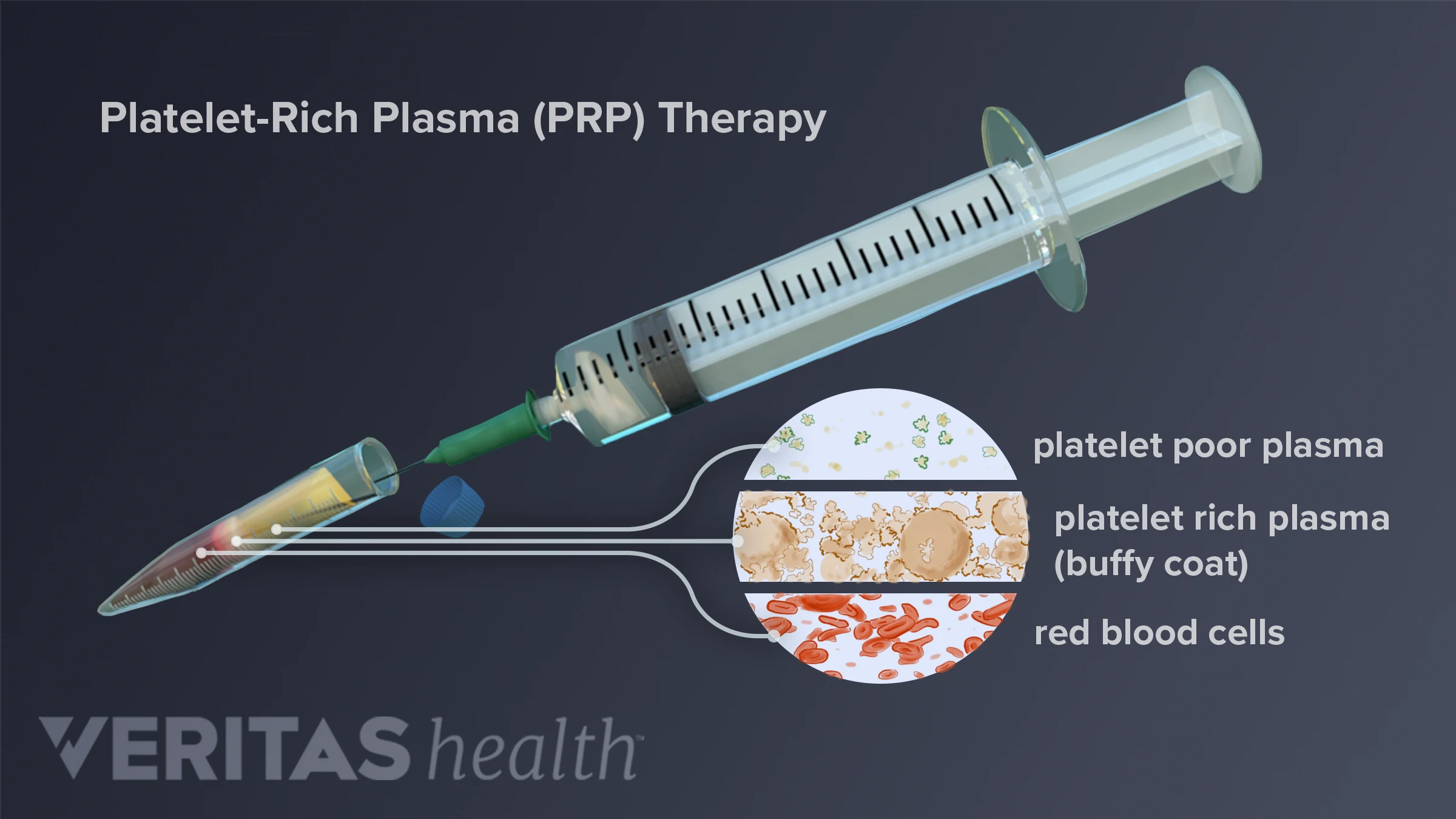Platelet-Rich Plasma Injection Procedure